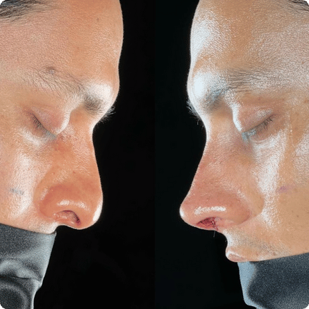 Caso de rinoplastia ultrasónica, perfil antes y después del procedimiento